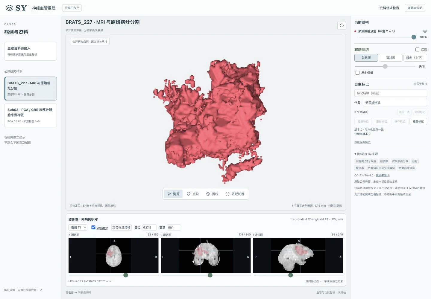 BRATS_227 MRI 与病灶表面在 神外血管重建系统中的联动界面