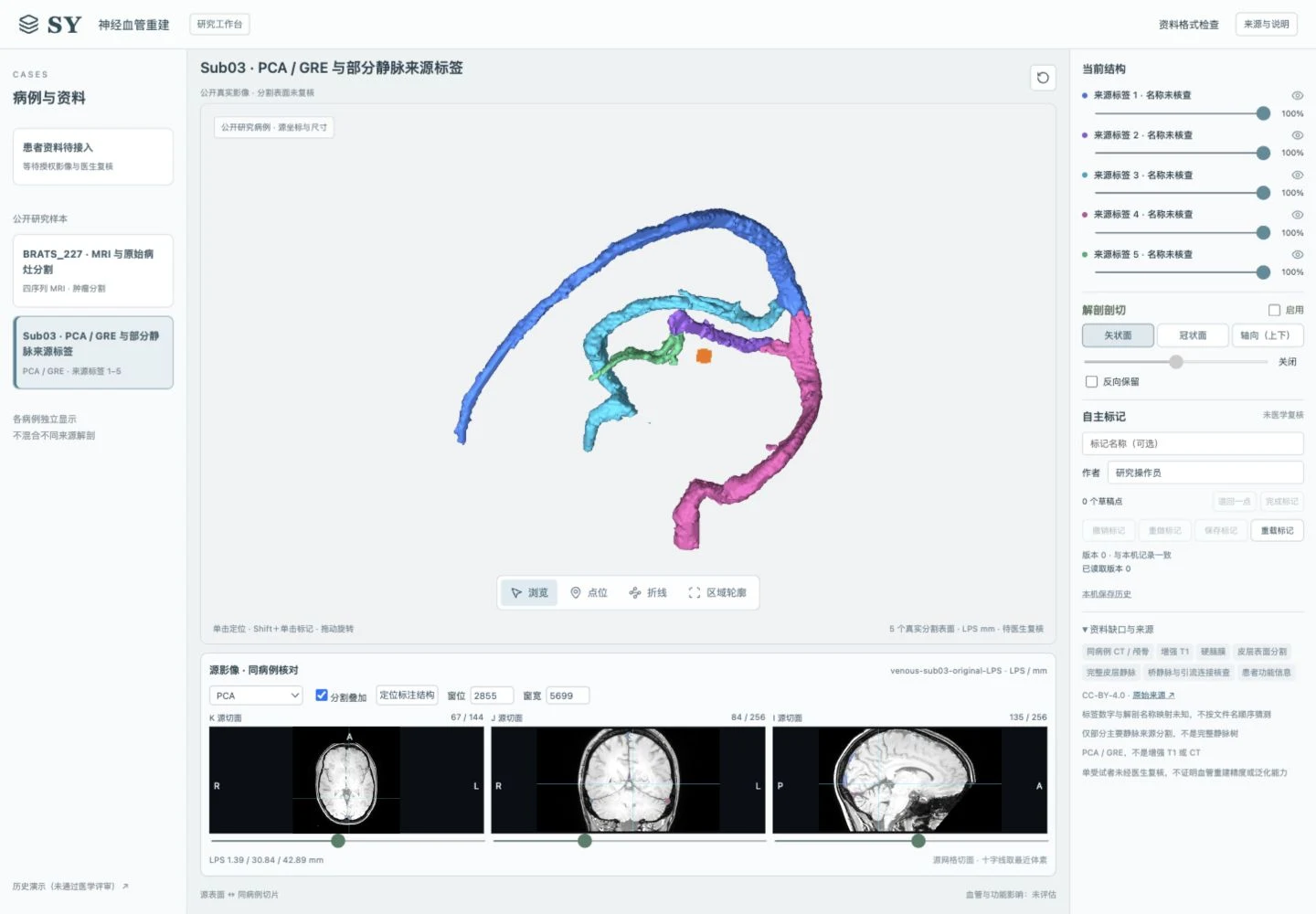神外血管重建系统中的静脉来源分割表面与三向 MRI 切片